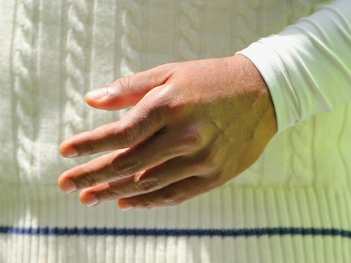 Kumar Sangakkara's fractured hand