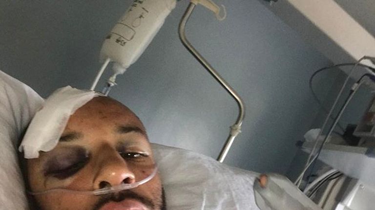 James Ellington is still on the road to recovery after suffering multiple injuries in a motorbike crash - credit: Instagram/jimmyells