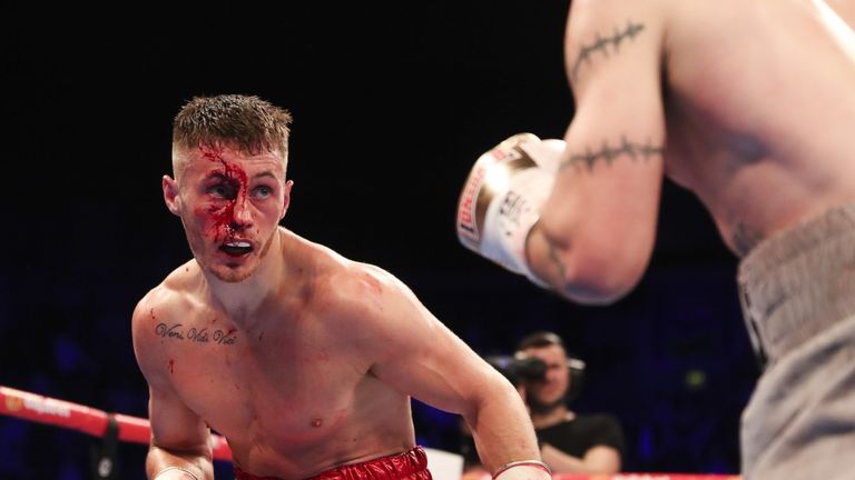 Burnett suffered a serious cut above his right eye against Lee Haskins