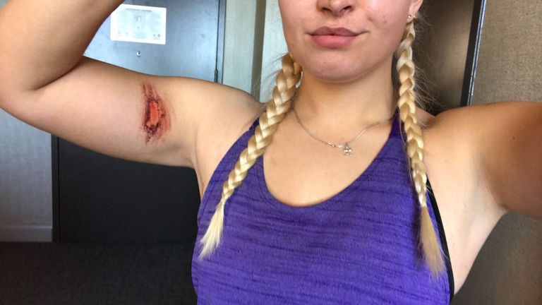 Kinghorn shows off her war wounds from the marathon at the weekend