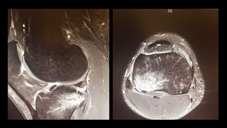 Chamberlain's right knee was damaged in the opening round