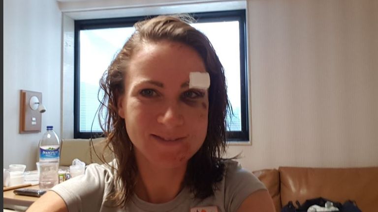 Annemiek van Vleuten reveals her facial injuries (Twitter @AvVleuten) 