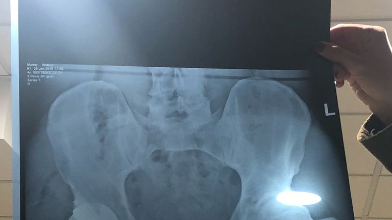 The X-ray shows Murray's new metal hip (via @andymurray on Instagram)